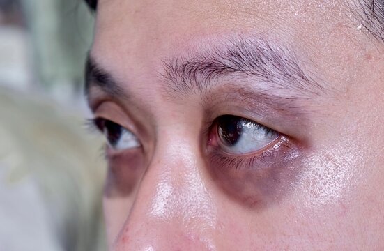 Raccon eyes or periorbital ecchymosis or panda eye sign in Asian male patient.