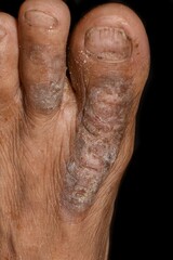 Eczema or fungal infection in foot of Asian man.