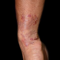 Fungal infection called tinea corporis in forearm of Asian man.