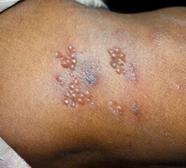 Herpes simplex infection at lower back. Small and painful vesicles.