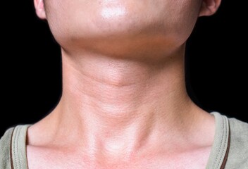 Aging skin folds or skin creases or wrinkles at neck of Asian young man.