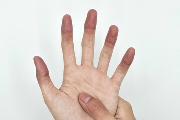Cyanotic hands or peripheral cyanosis or blue hands at Asian man