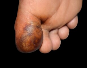 Abscess and cellulitis or Staphylococcal, Streptococcal skin infection at the big toe of Asian male patient.