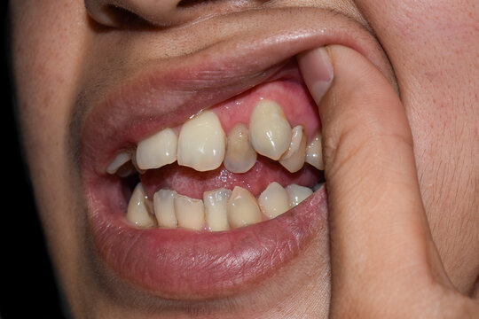 Stacked or overlapping canine teeth of Asian man. Also called crowded teeth.