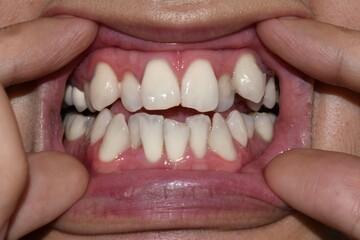 Stacked or overlapping white teeth. Also called crowded teeth. - obrazy, fototapety, plakaty