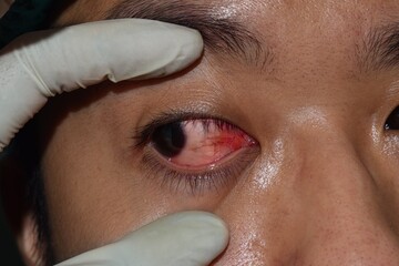 Corneal infection or ulcer called keratitis in Asian woman.