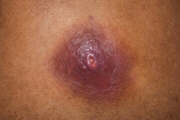 Large carbuncle or abscess at the back of Asian female patient. - obrazy, fototapety, plakaty