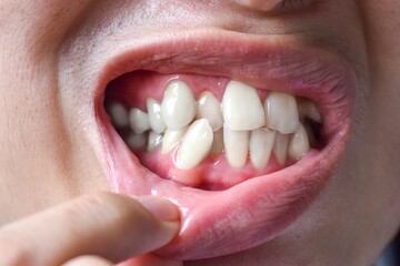 Stacked or overlapping white teeth. Also called crowded teeth.