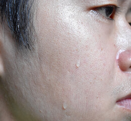 Excessive sweating or hyperhidrosis and oily skin at face of Asian, adult young man. Oily skin is...