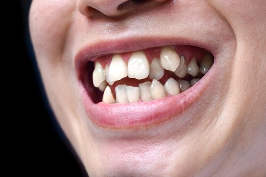 Stacked or overlapping white teeth. Also called crowded teeth.