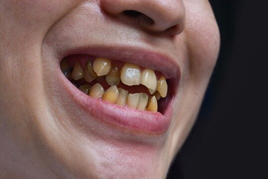 Crowded teeth with tobacco stains. Poor oral hygiene.