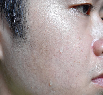 Excessive sweating or hyperhidrosis and oily skin at face of Asian, adult young man. Oily skin is the result of overproduction of sebum from sebaceous glands.
