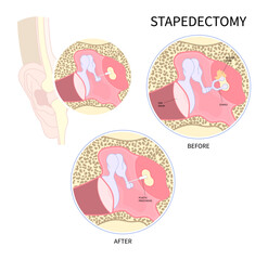 Fototapeta na wymiar stapedectomy surgical for hearing loss and meniere's syndrome Balance problem