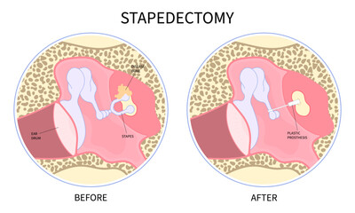 Meniere's syndrome with stapedectomy surgical for hearing loss and Balance problem