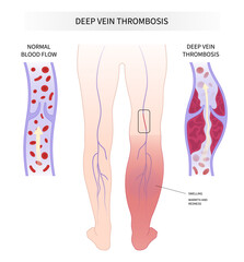 Blood Clot disease chronic Leg Pain varicose veins Swelling obesity ankle Foot diabetes syndrome - obrazy, fototapety, plakaty