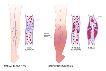 Leg Pain Swelling Blood Clot disease chronic varicose veins obesity ankle Foot diabetes syndrome - obrazy, fototapety, plakaty