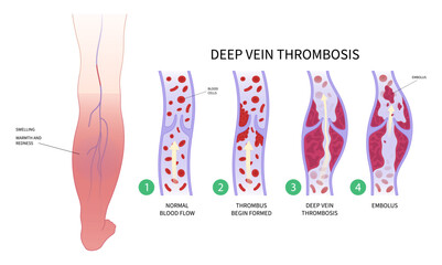 diabetes Foot chronic Leg Pain varicose veins Swelling obesity ankle syndrome Blood Clot disease