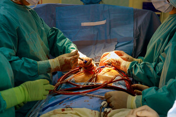 Coronary artery bypass graft CABG is performed in the hospital operating room for treatment of heart diseases because coronary heart disease.