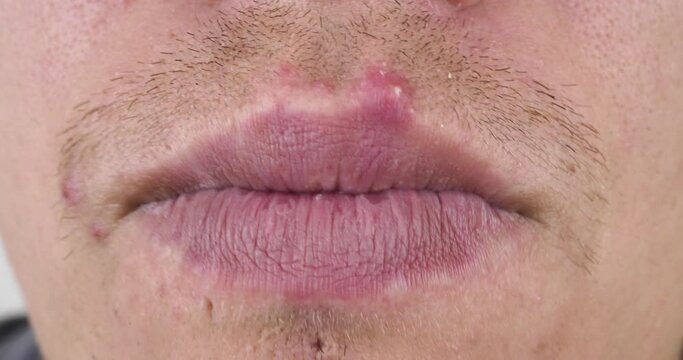 pimple covered face near the mouth, herpes virus on lips closeup. High quality 4k footage