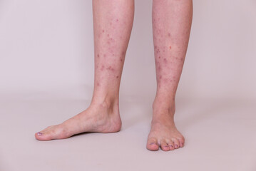 Female legs with many red spot and scar, insect bites on legs