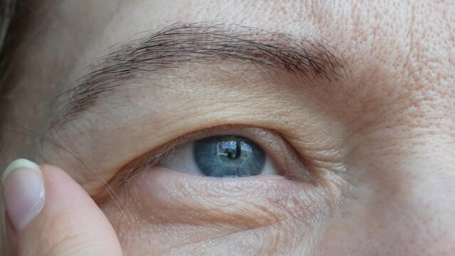 middle aged female's eye with drooping eyelid. Ptosis is a drooping of the upper eyelid, lazy eye. Cosmetology and facial concept, first wrinkles