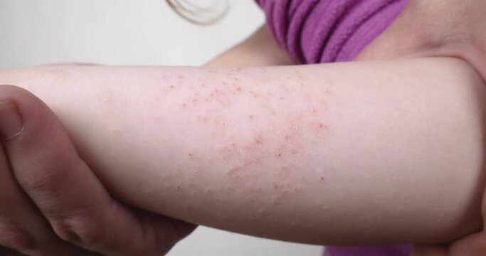 red allergy rash dermatitis on baby hand close up. High quality 4k footage