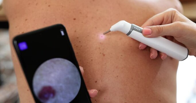Oncologist examines patient pigmented nevus using dermatoscope and smartphone