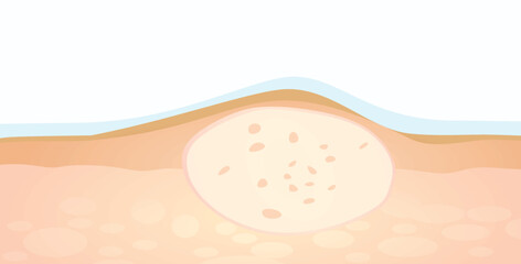Acne structure on skin. vector