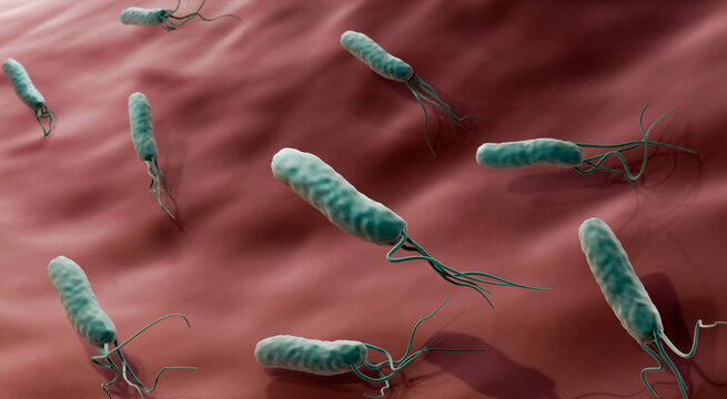 Helicobacter pylori is a bacteria causing ulcers and gastritis