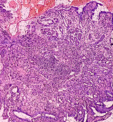 Tissue from gastro-jejunostomy stomal site (endoscopic biopsy): Chronic nonspecific gastritis with...