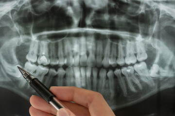 Close-up of panoramic dental x-ray. Pen points to abnormal location of wisdom teeth on lower jaw...