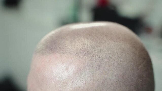 Man in micropigmentation treatment. salon. Making hair on bald scalp. Tattooing head. Hair micro pigmentation. Using professional equipment. Zoom, closeup. Camera moving. Showing after treatment.