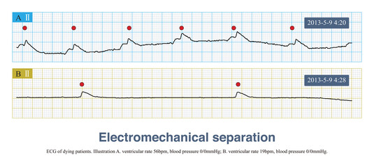 Electromechanical separation is an ECG of cardiac arrest. The heart has only electrical activity, but no mechanical activity, so heart sounds and BP disappear.