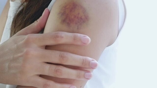 A woman in a white T-shirt by the window touches a large bruise on her arm with her hand. Domestic violence concept.