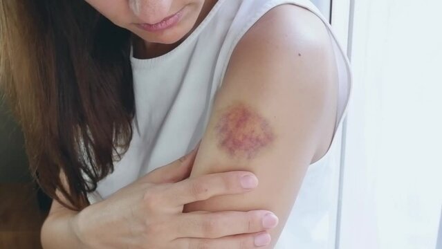 A woman in a white T-shirt by the window touches a large bruise on her arm with her hand. Domestic violence concept.