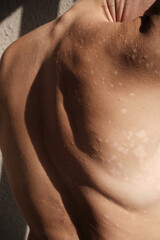 Close-up psoriasis skin, eczema, rash and other skin diseases. Spots on the skin. Naked neck, back,...