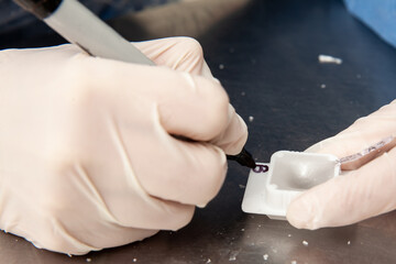 Scientist preparing paraffin blocks containing biopsy tissue for sectioning. Pathology laboratory....