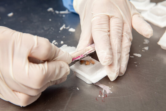 Scientist preparing paraffin blocks containing biopsy tissue for sectioning. Pathology laboratory. Cancer diagnosis.