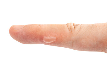 blister on finger skin, human body damage callus, health care theme, injury worker forefinger with dry skin close-up isolated on white background.