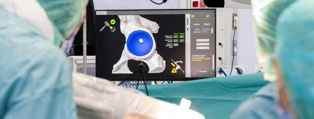 Team of doctor perform total hip arthroplasty replacement surgery in osteoarthritis patient inside...