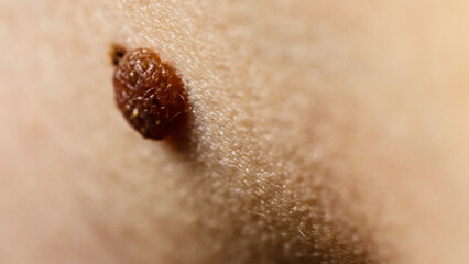 Closeup brown mole on skin.