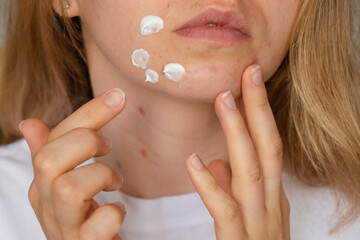 Unrecognizable woman applies makeup, cream serum cure for acne on face. Close-up acne on woman's...