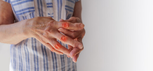 close-up, an old woman makes herself a hand massage, arthritis, arthrosis