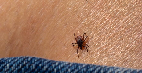 The parasite mite sits on a persons skin. infection carrier. Ixodes ricinus