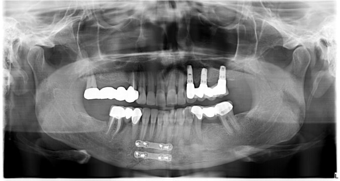 Operated mandibular fracture caused by punch