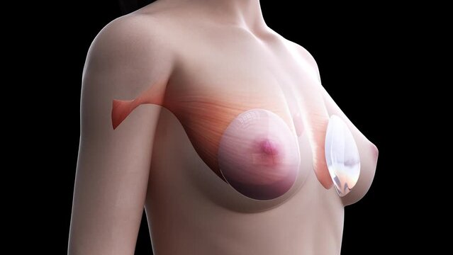 3d rendered medical animation of  breast implants