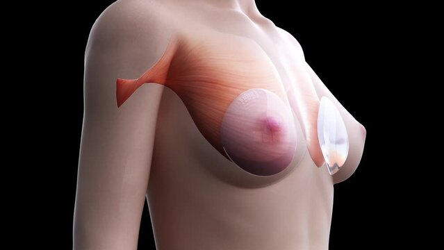 3d rendered medical animation of  breast implants