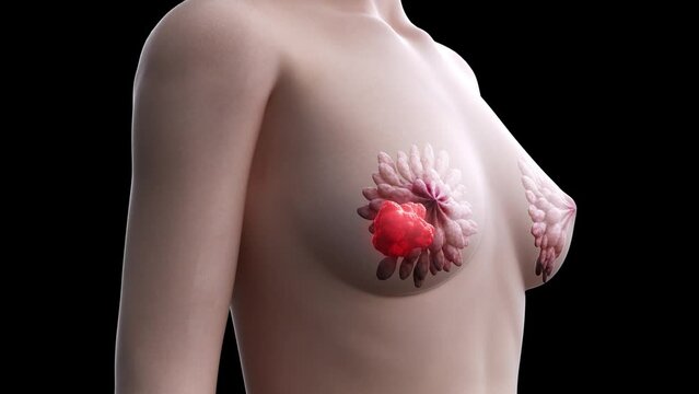 3d rendered medical animation of  breast cancer