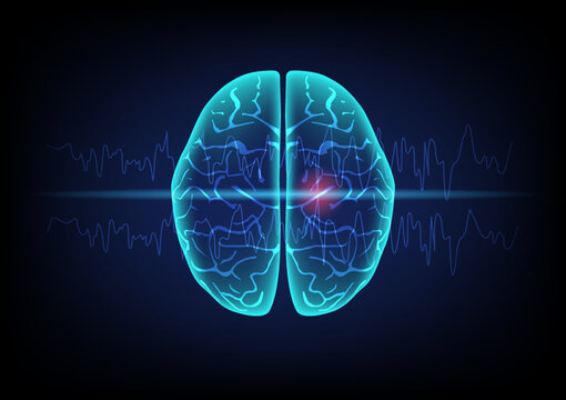 Illustration of human brain and brain waves on technology background. Concept of focal seizure.