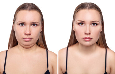 Woman before and after chin correction. Plastic surgery concept. - obrazy, fototapety, plakaty